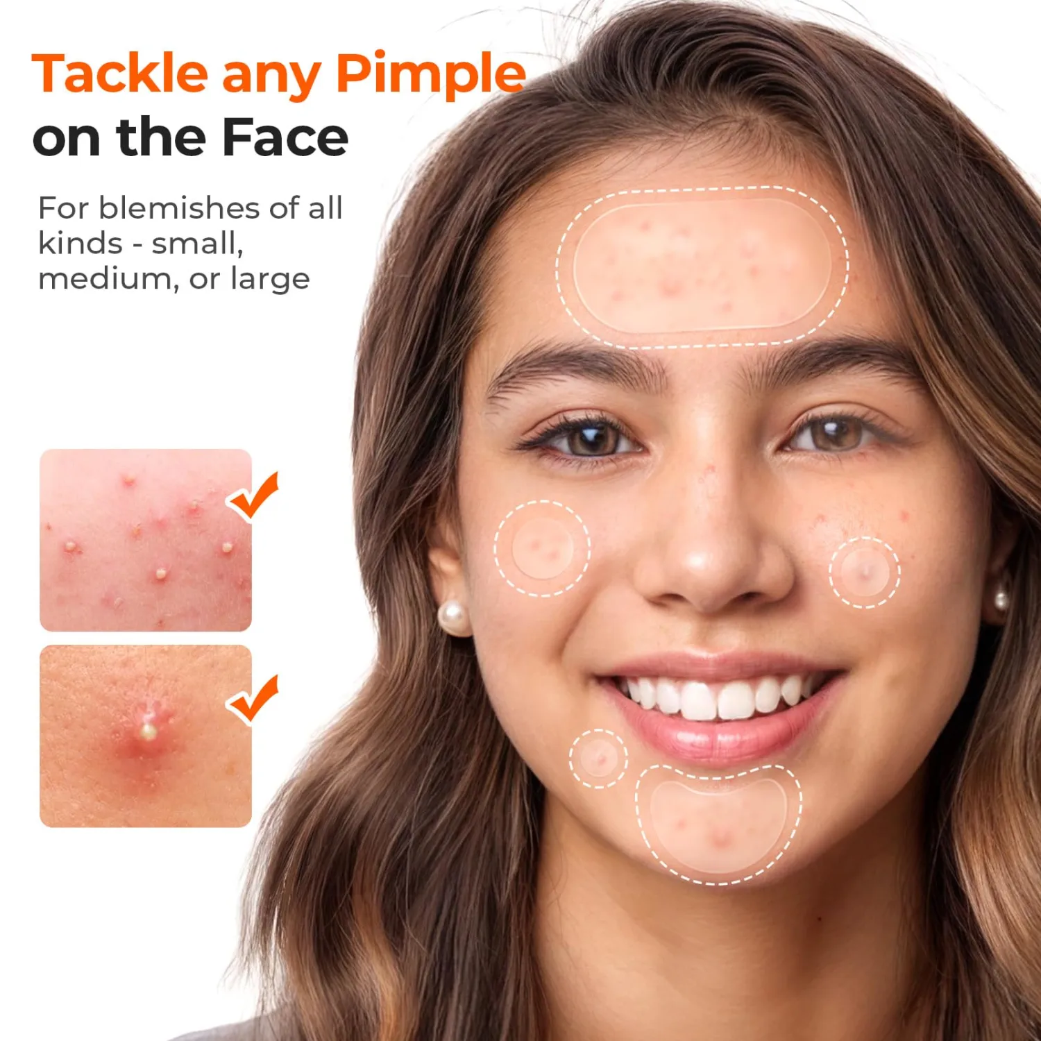 TKTK 609 Count Pimple Patches for Face, Hydrocolloid Acne Cover Patch Bulk